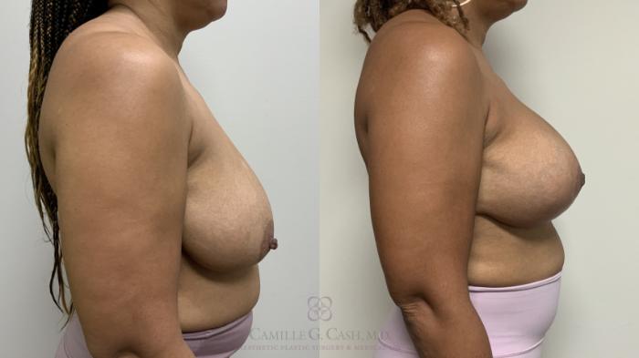 Before & After Breast Lift Case 658 Right Side View in Houston, TX