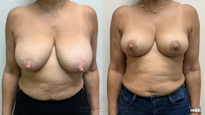 Before & After Breast Lift Case 702 Front View in Houston, TX
