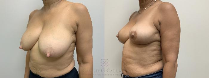 Before & After Liposuction Case 702 Left Oblique View in Houston, TX