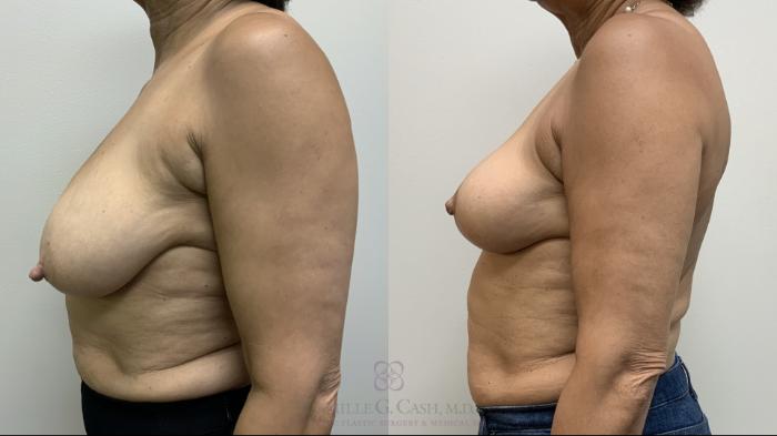 Before & After Breast Reduction Case 702 Left Side View in Houston, TX