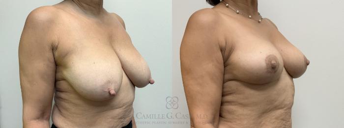 Before & After Breast Reduction Case 702 Right Oblique View in Houston, TX