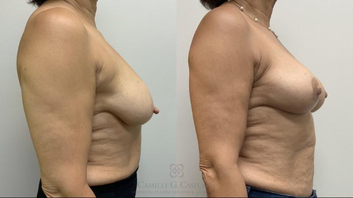 Before & After Breast Reduction Case 702 Right Side View in Houston, TX