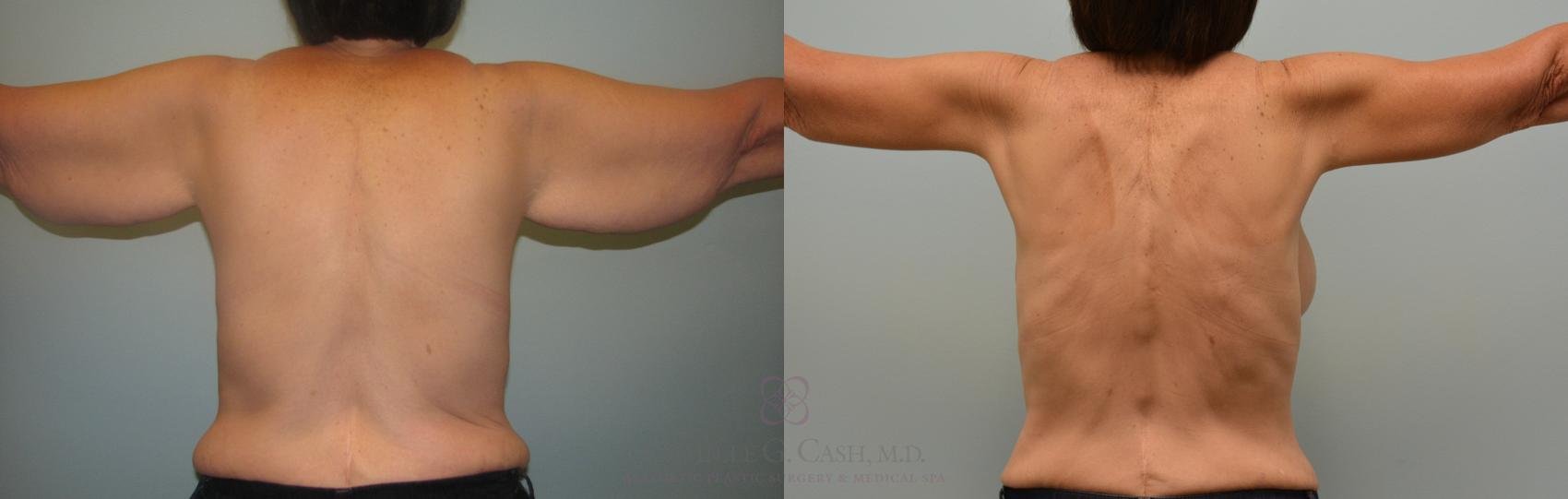 Before & After Arm Lift Case 111 Back View in Houston, TX