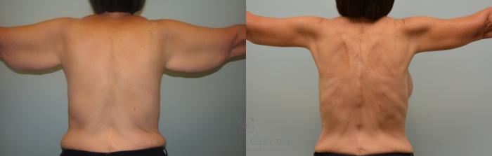 Before & After Post-Weight Loss Body Contouring Case 111 Back View in Houston, TX