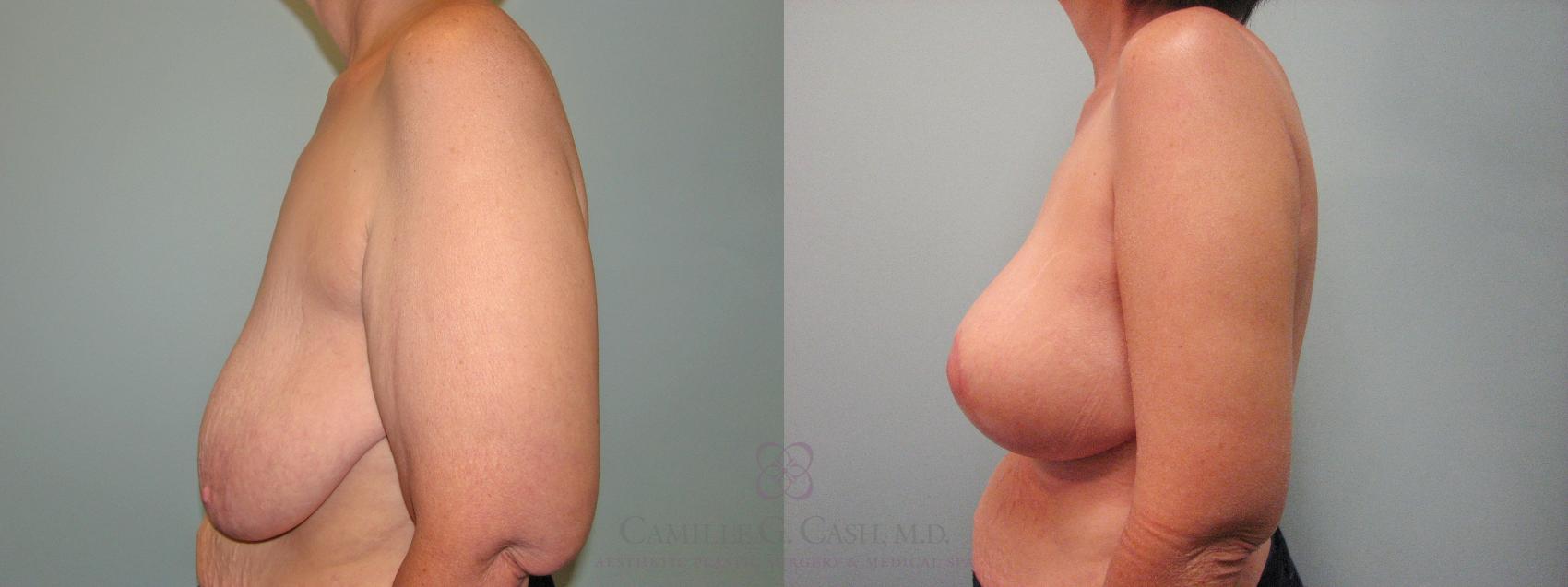 Before & After Post-Weight Loss Breast Enhancement Case 111 Left Side View in Houston, TX