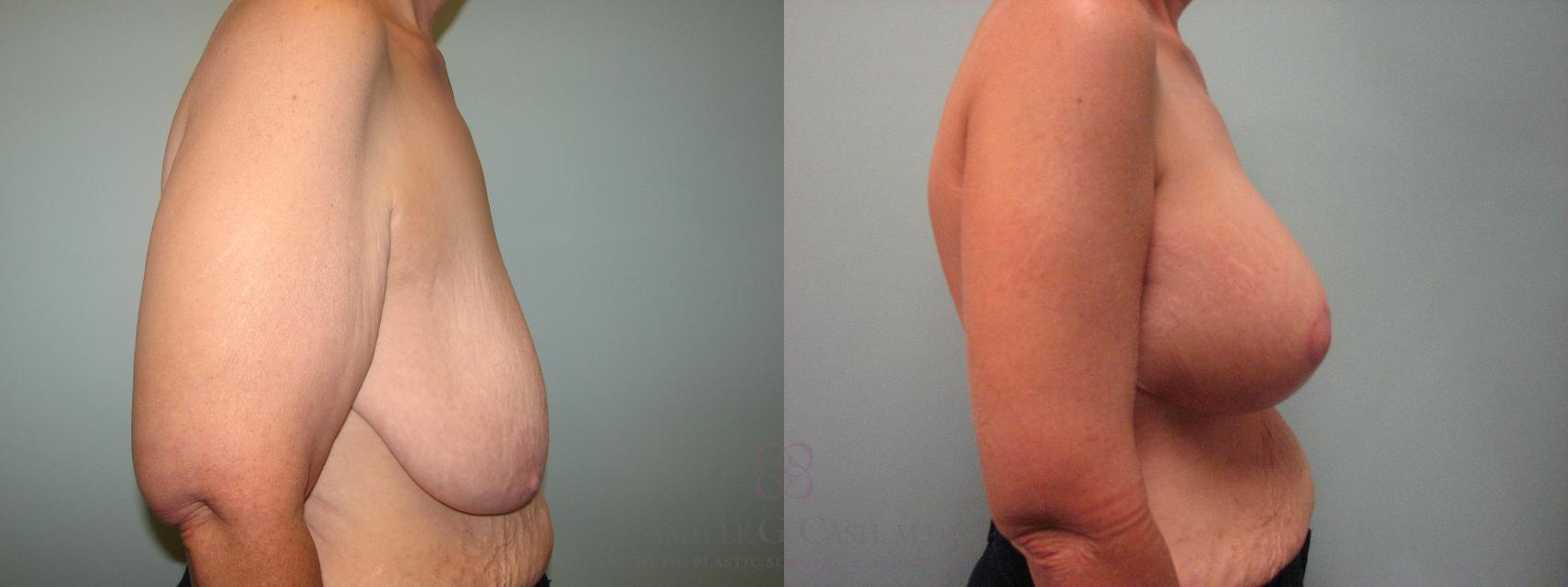 Before & After Breast Lift with Implants Case 111 Right Side View in Houston, TX