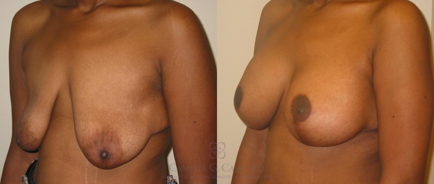 Before & After Breast Lift with Implants Case 140 View #1 View in Houston, TX