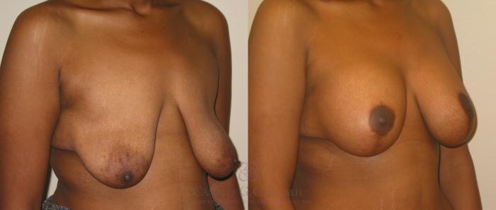 Before & After Breast Lift with Implants Case 140 View #2 View in Houston, TX