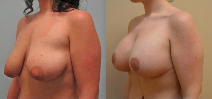 Before & After Post-Weight Loss Breast Enhancement Case 150 Left Oblique View in Houston, TX