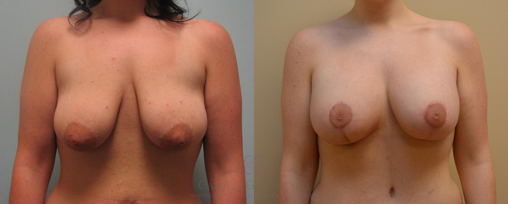 Before & After Breast Lift with Implants Case 150 View #1 View in Houston, TX