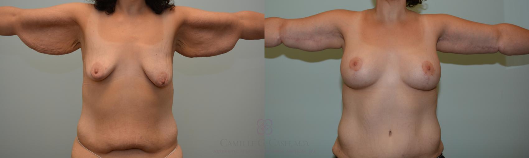Before & After Arm Lift Case 193 View #1 View in Houston, TX