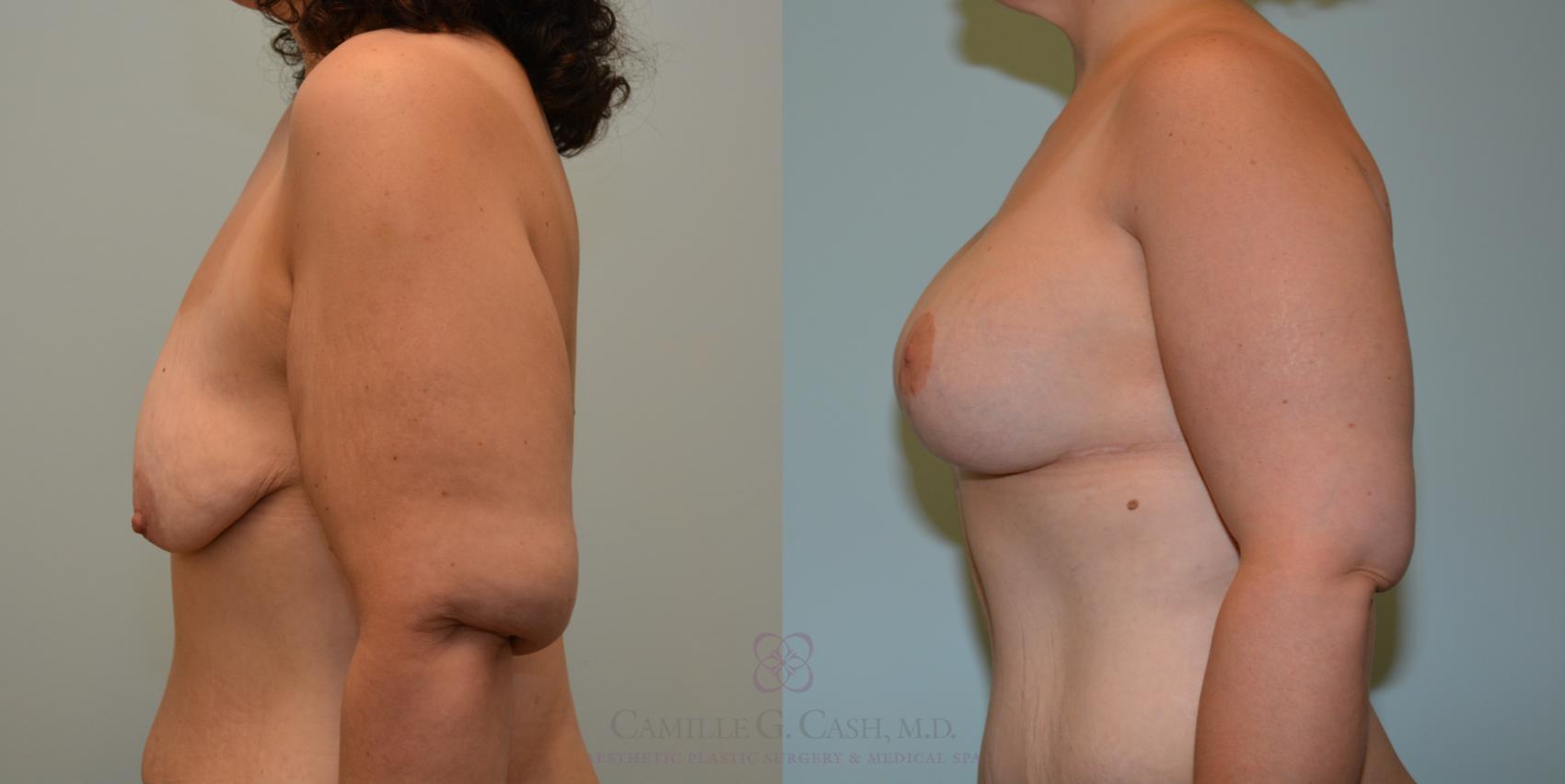 Before & After Post-Weight Loss Breast Enhancement Case 193 View #2 View in Houston, TX