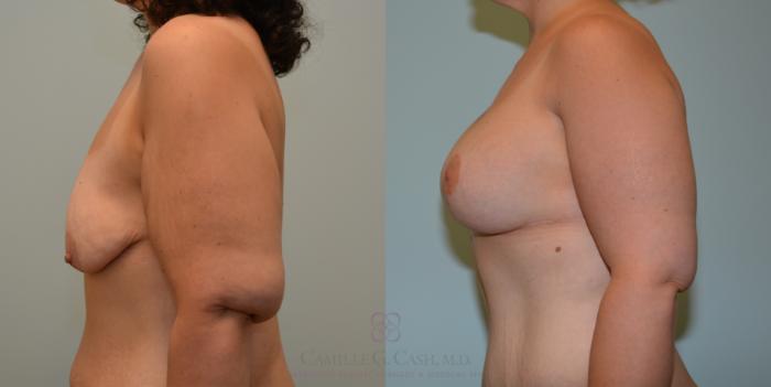 Before & After Post-Weight Loss Body Contouring Case 193 View #2 View in Houston, TX