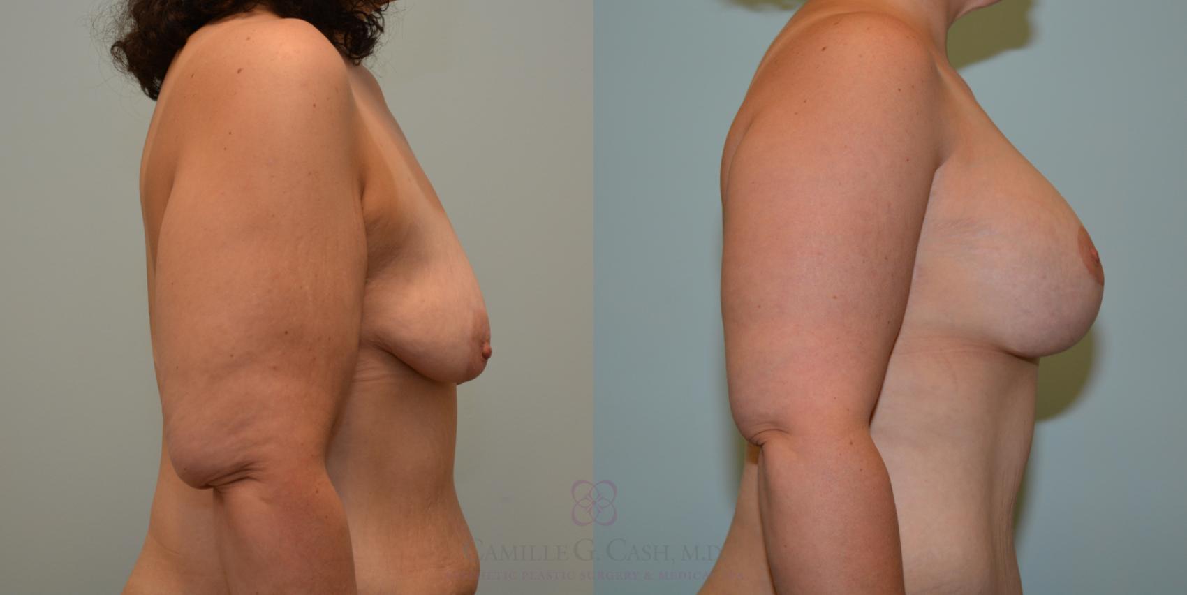 Before & After Breast Lift with Implants Case 193 View #3 View in Houston, TX