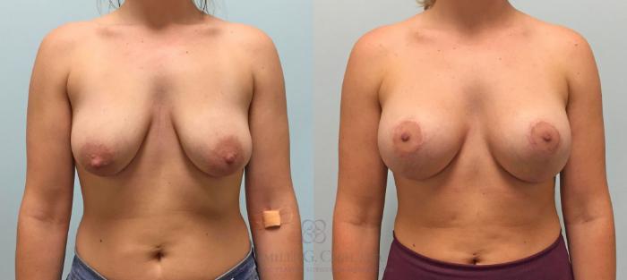 Before & After Breast Lift with Implants Case 208 View #1 View in Houston, TX