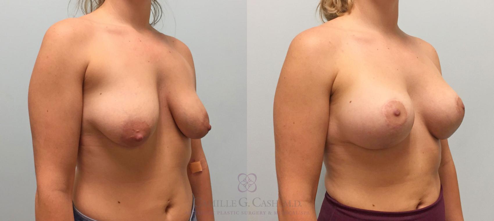 Before & After Breast Lift with Implants Case 208 View #2 View in Houston, TX