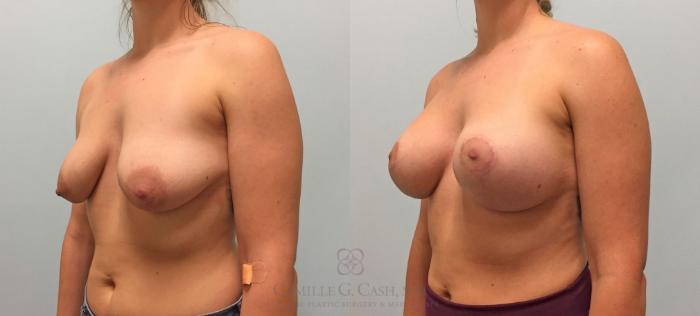 Before & After Breast Lift with Implants Case 208 View #3 View in Houston, TX