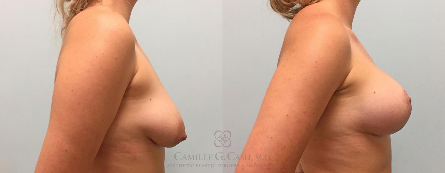 Before & After Breast Lift with Implants Case 208 View #4 View in Houston, TX