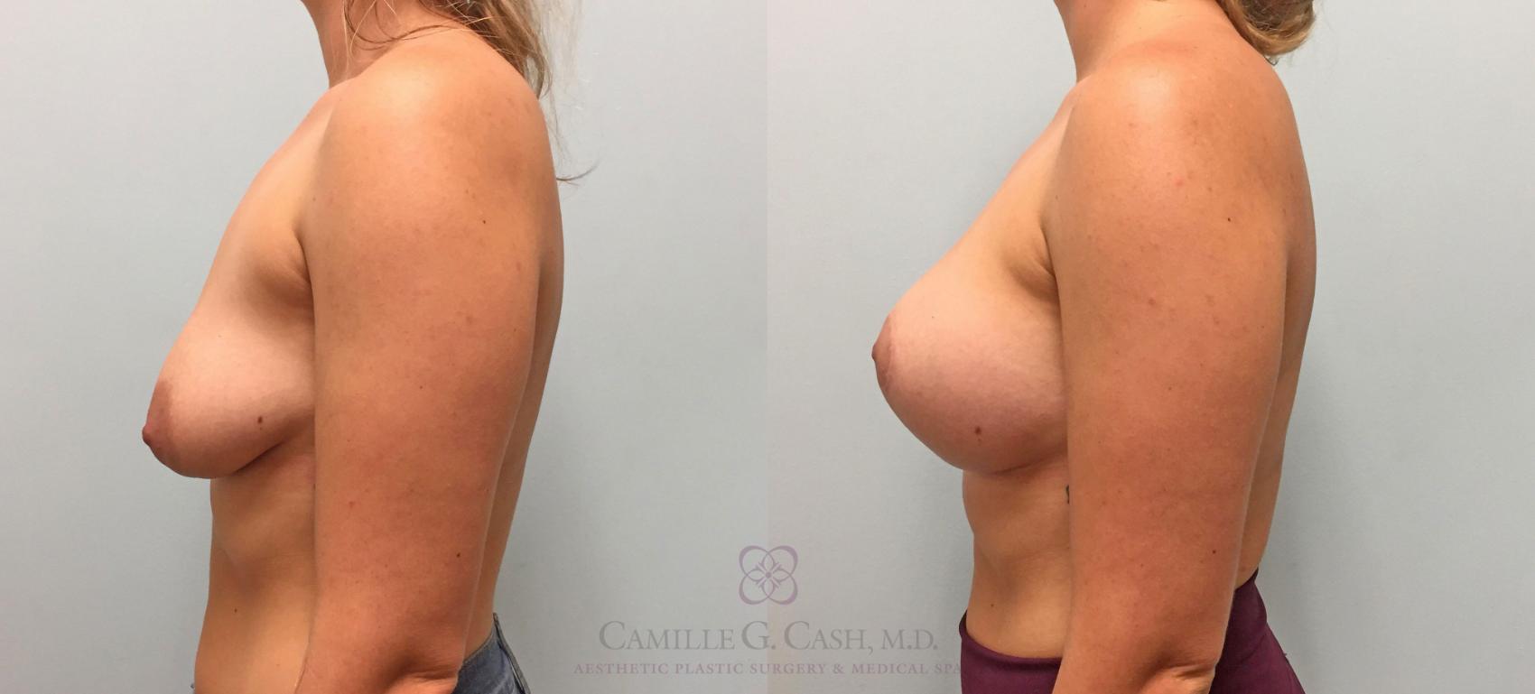 Before & After Breast Lift with Implants Case 208 View #5 View in Houston, TX