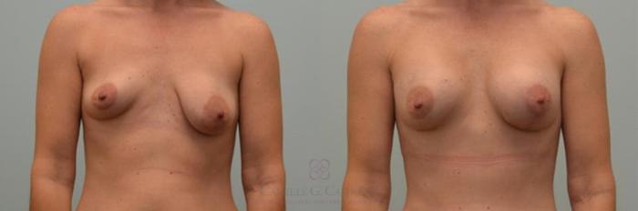 Before & After Breast Lift with Implants Case 251 View #1 View in Houston, TX