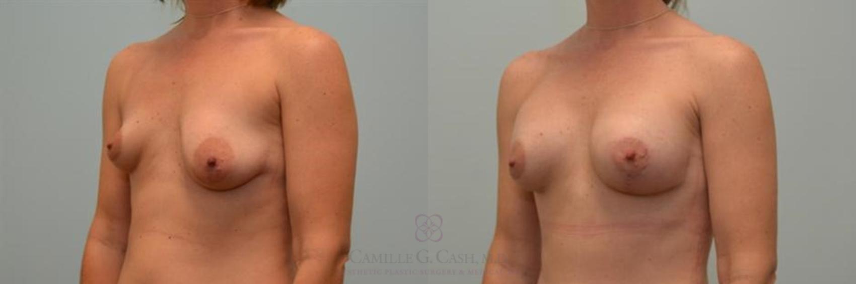 Before & After Breast Lift with Implants Case 251 View #2 View in Houston, TX
