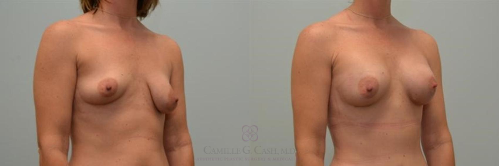 Before & After Breast Lift with Implants Case 251 View #3 View in Houston, TX