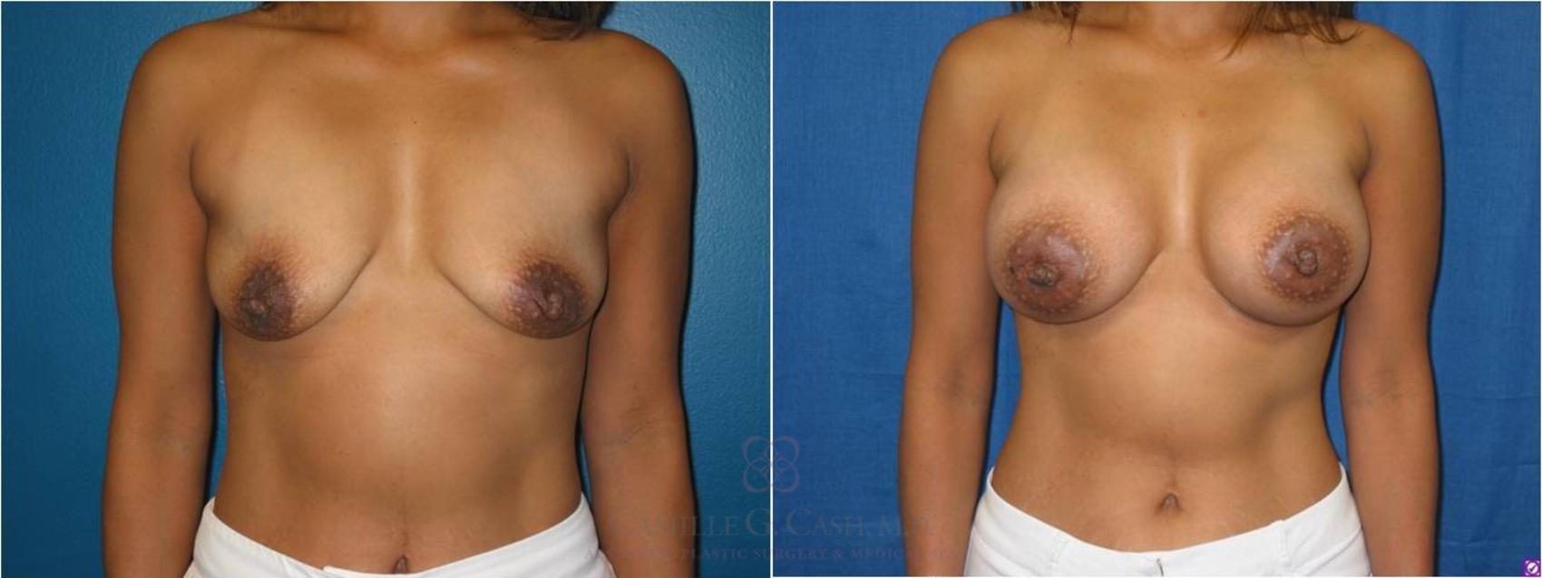 Before & After Breast Lift with Implants Case 27 View #1 View in Houston, TX