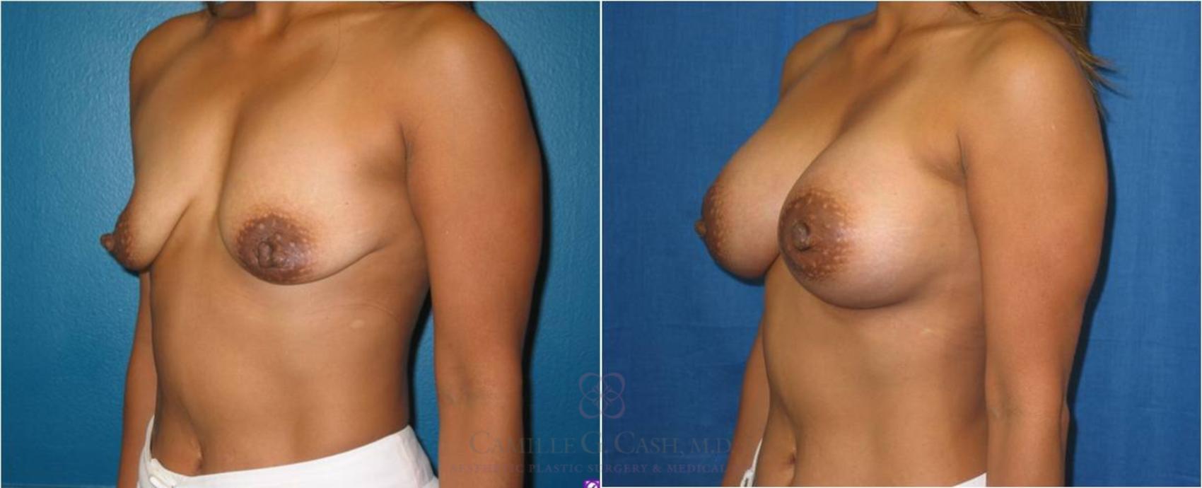 Before & After Breast Lift with Implants Case 27 View #2 View in Houston, TX
