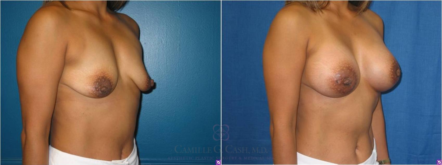 Before & After Breast Lift with Implants Case 27 View #3 View in Houston, TX