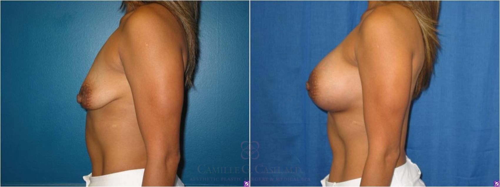 Before & After Breast Lift with Implants Case 27 View #4 View in Houston, TX