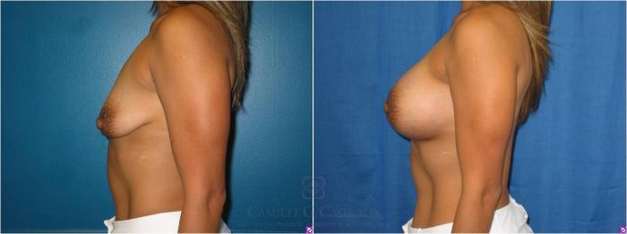 Before & After Breast Lift with Implants Case 27 View #4 View in Houston, TX