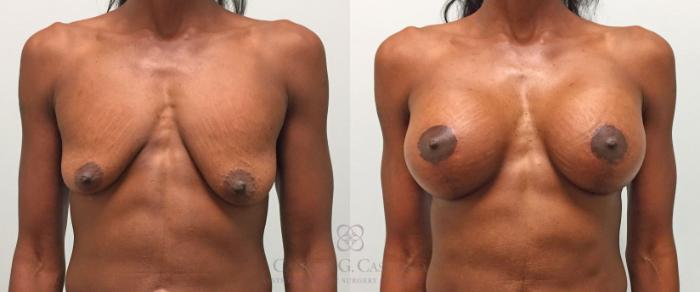 Before & After Breast Lift with Implants Case 287 View #1 View in Houston, TX