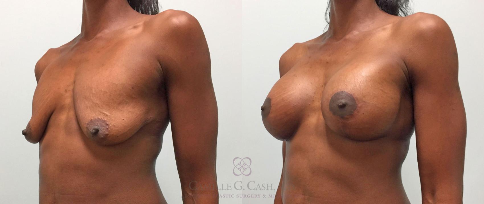 Before & After Breast Lift with Implants Case 287 View #2 View in Houston, TX