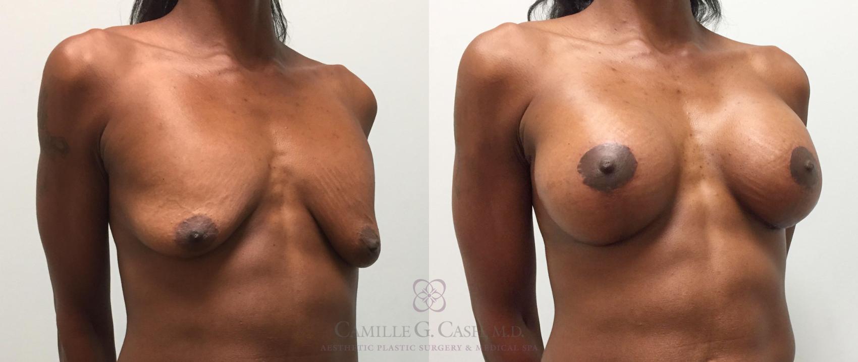 Before & After Breast Lift with Implants Case 287 View #3 View in Houston, TX