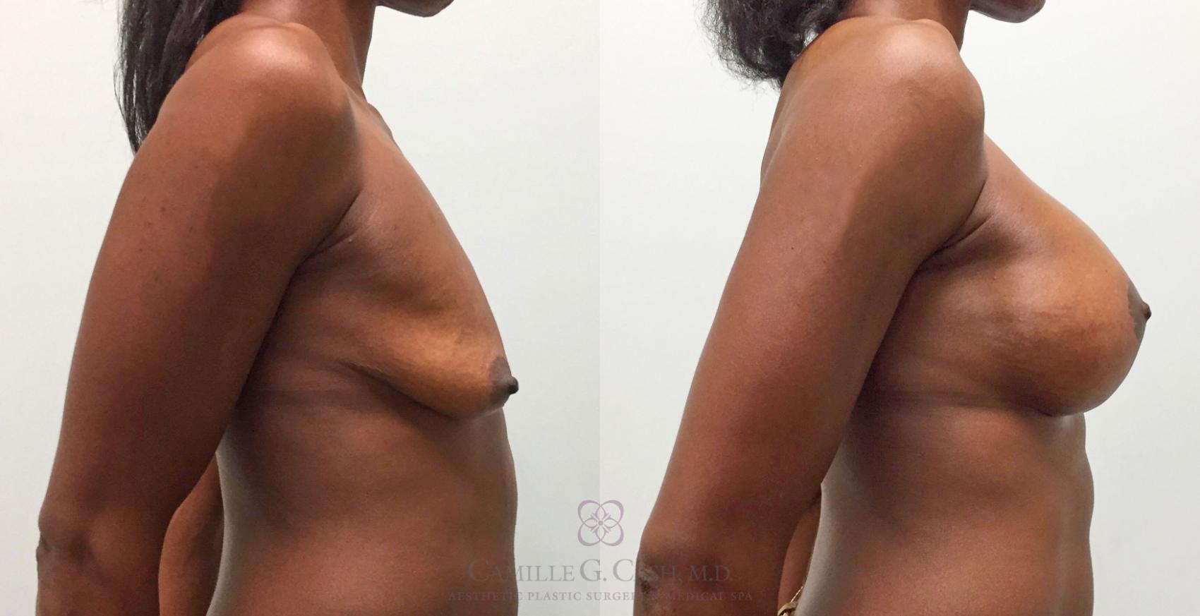 Before & After Breast Lift with Implants Case 287 View #4 View in Houston, TX