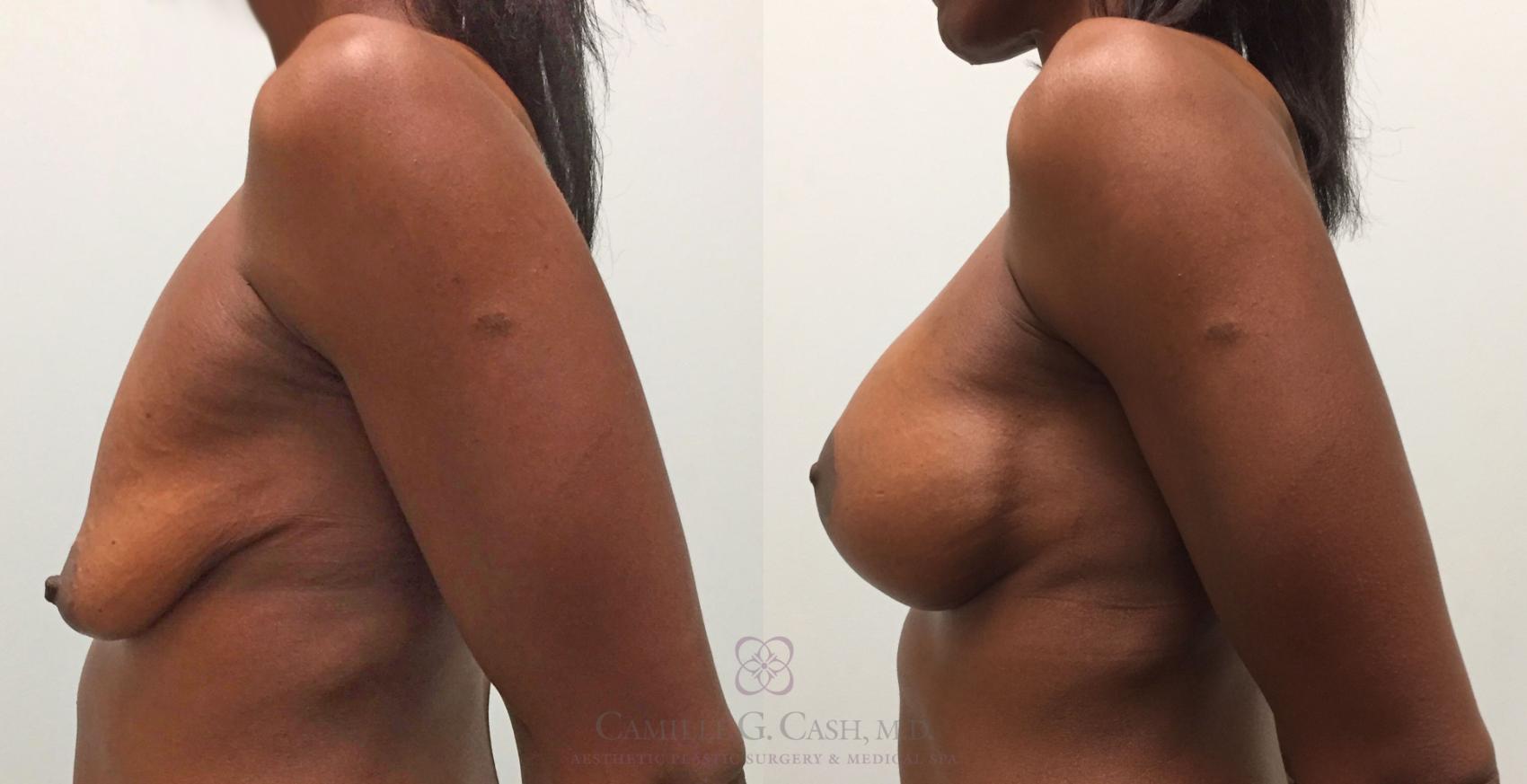 Before & After Breast Lift with Implants Case 287 View #5 View in Houston, TX