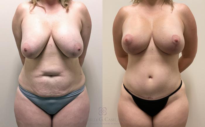 Before & After Breast Lift with Implants Case 327 View #1 View in Houston, TX