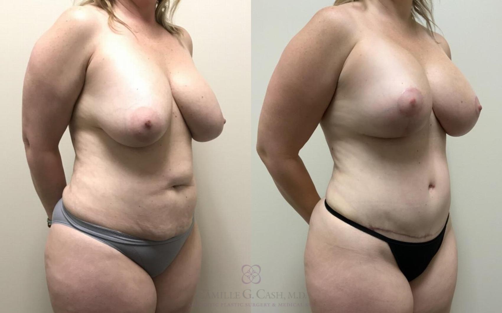 Before & After Breast Lift with Implants Case 327 View #2 View in Houston, TX