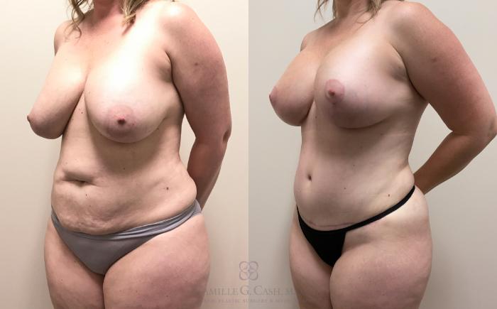 Before & After Breast Lift with Implants Case 327 View #3 View in Houston, TX