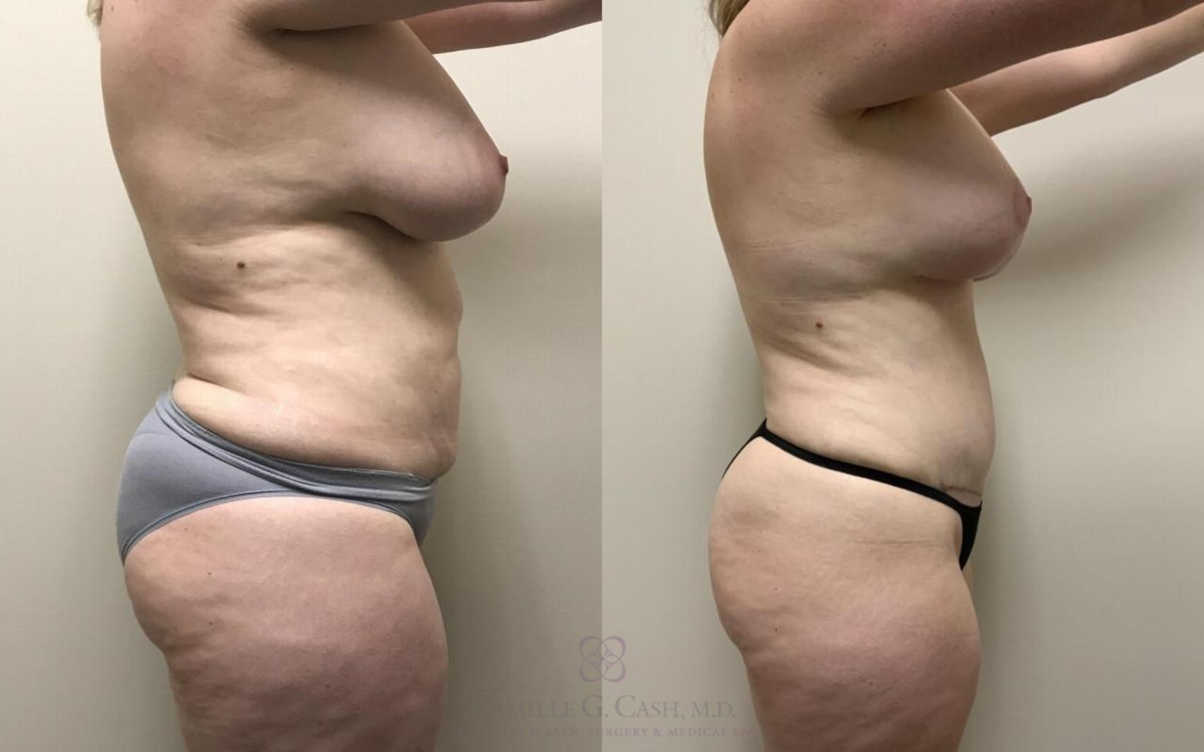 Before & After Breast Lift with Implants Case 327 View #4 View in Houston, TX