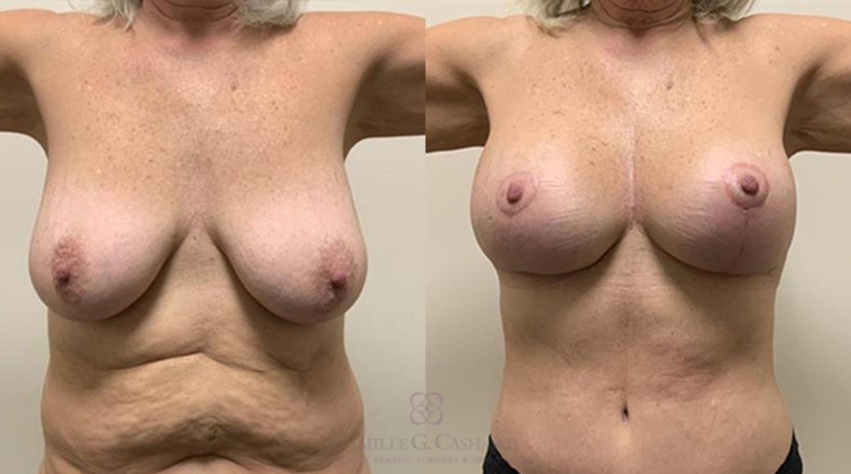 Before & After Breast Lift with Implants Case 365 View #1 View in Houston, TX