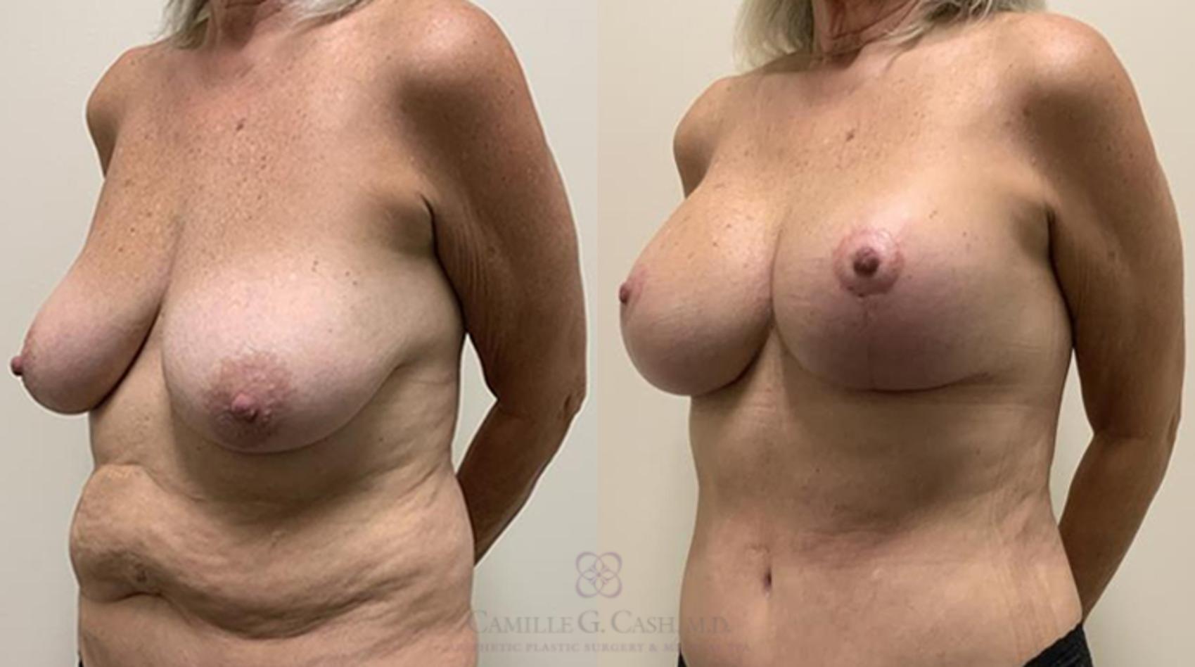 Before & After Breast Lift with Implants Case 365 View #2 View in Houston, TX