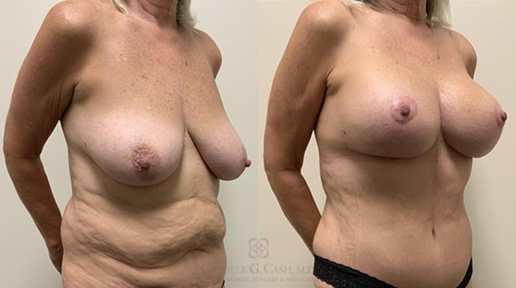 Before & After Breast Lift with Implants Case 365 View #3 View in Houston, TX