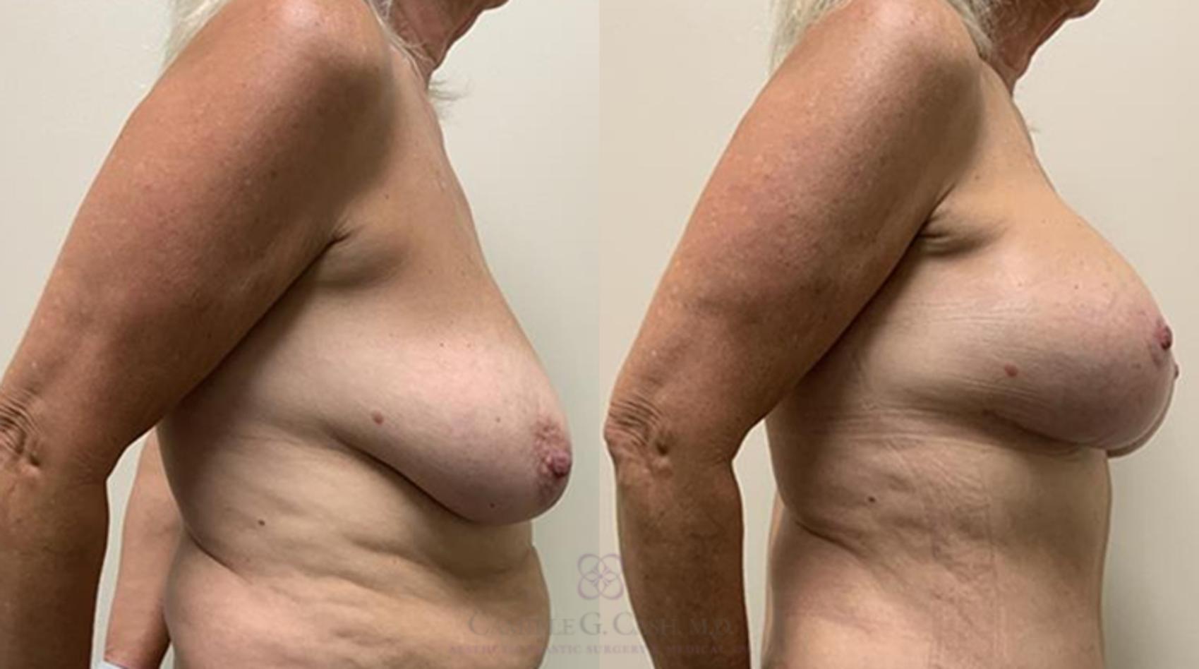 Before & After Breast Lift with Implants Case 365 View #4 View in Houston, TX