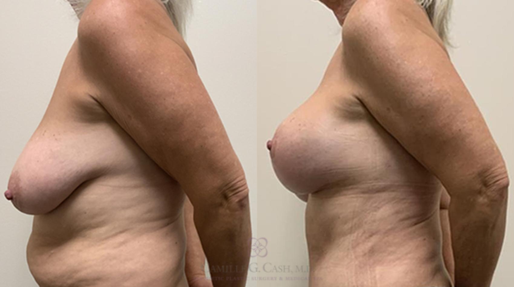 Before & After Breast Lift with Implants Case 365 View #5 View in Houston, TX
