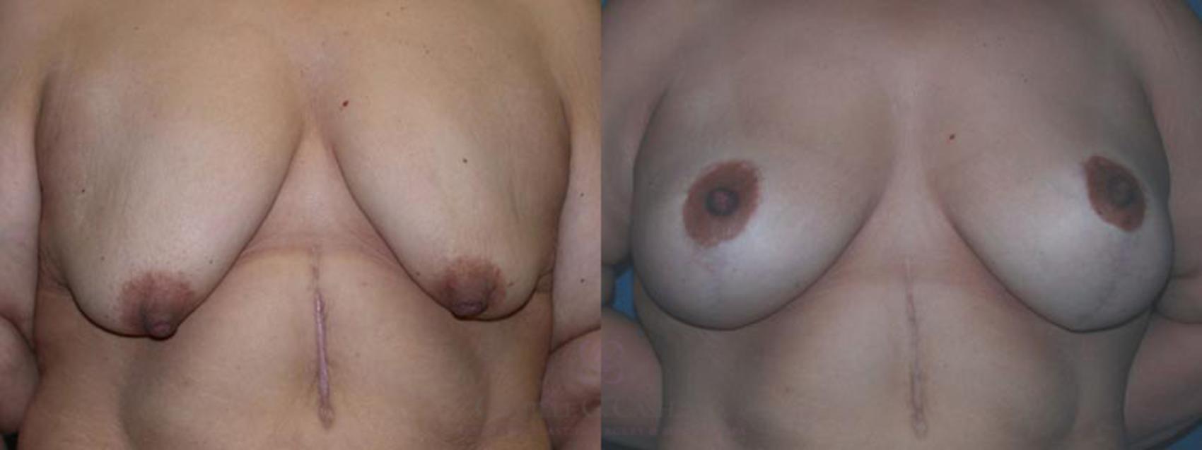 Before & After Breast Lift with Implants Case 4 View #1 View in Houston, TX