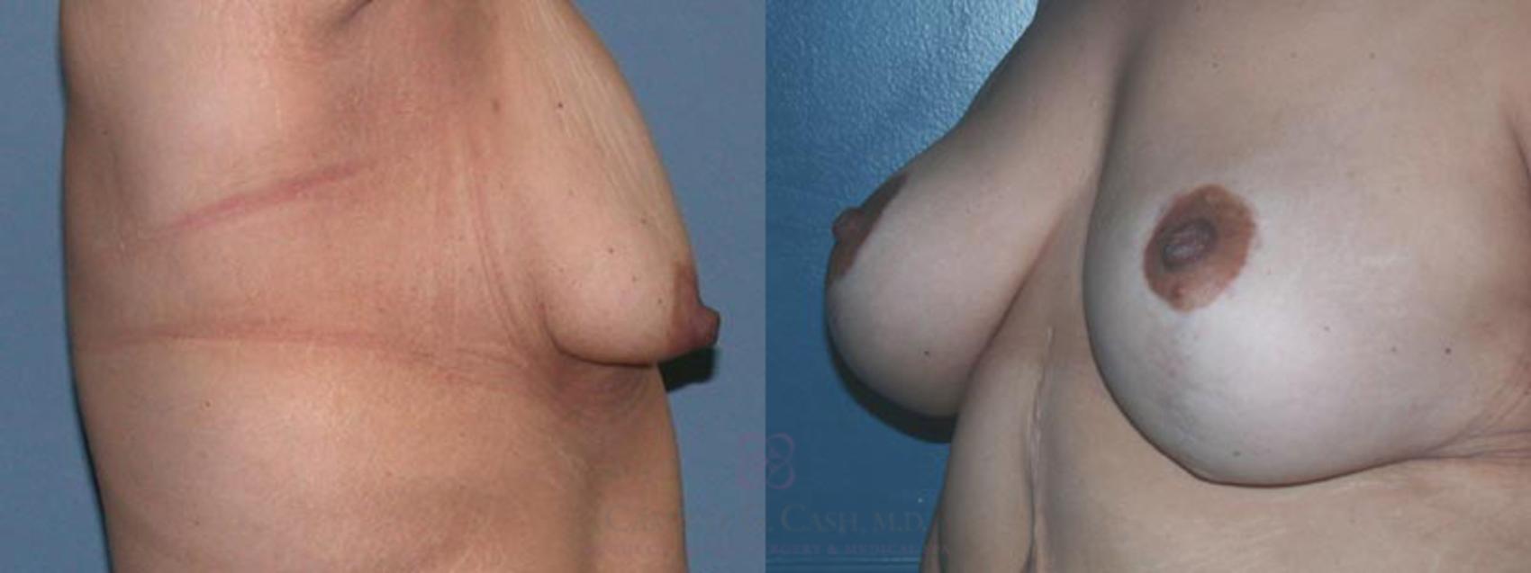 Before & After Breast Lift with Implants Case 4 View #2 View in Houston, TX