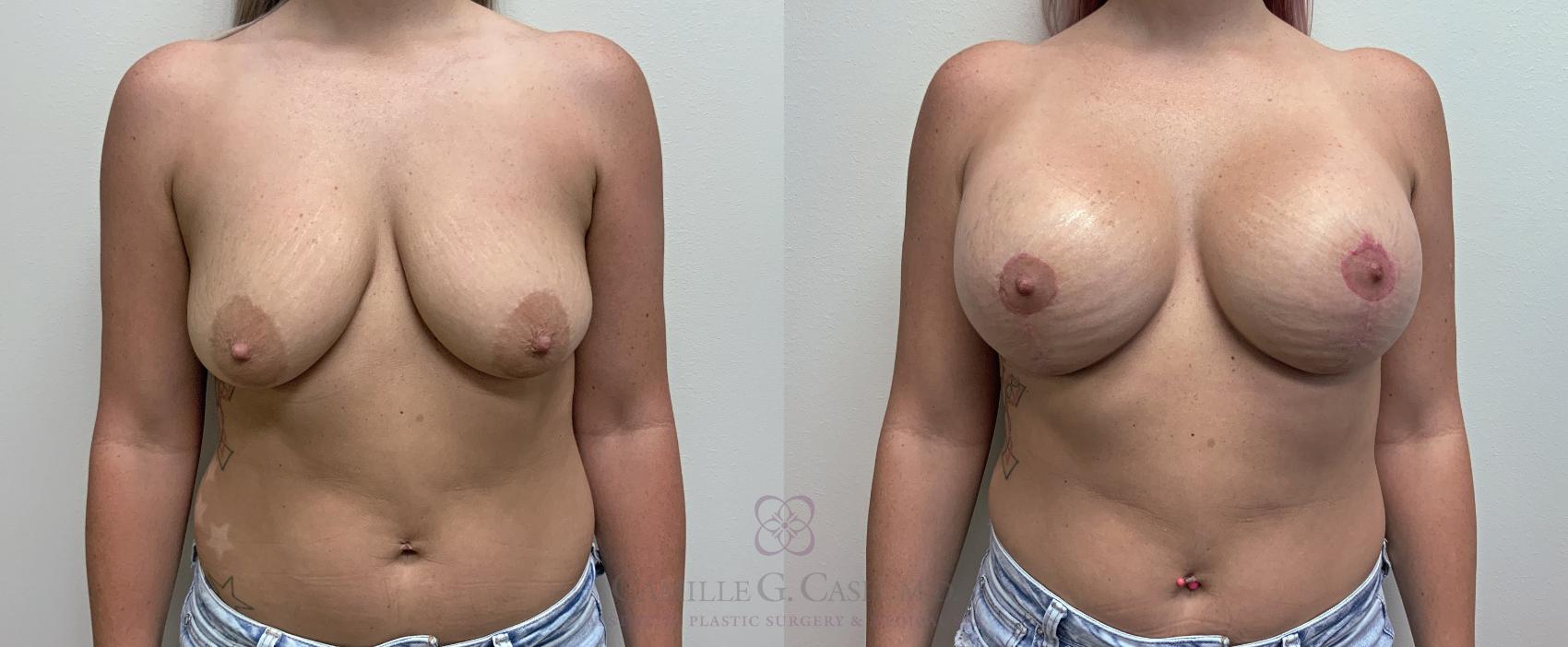 Before & After Breast Lift with Implants Case 454 Front View in Houston, TX