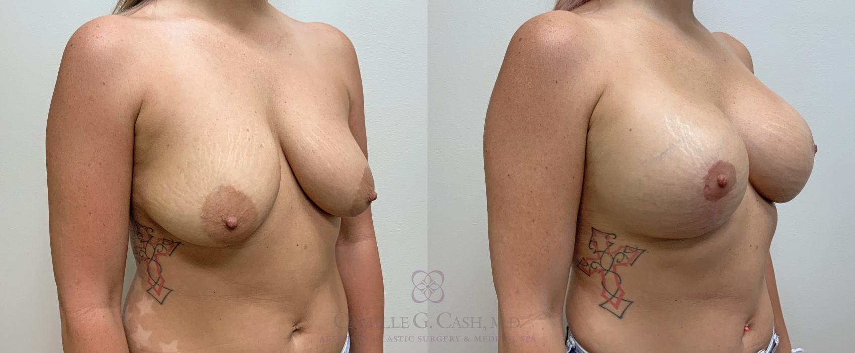 Before & After Breast Lift with Implants Case 454 Left Oblique View in Houston, TX