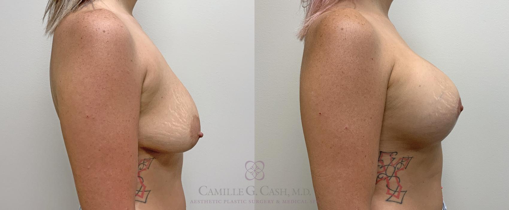 Before & After Breast Lift with Implants Case 454 Left Side View in Houston, TX